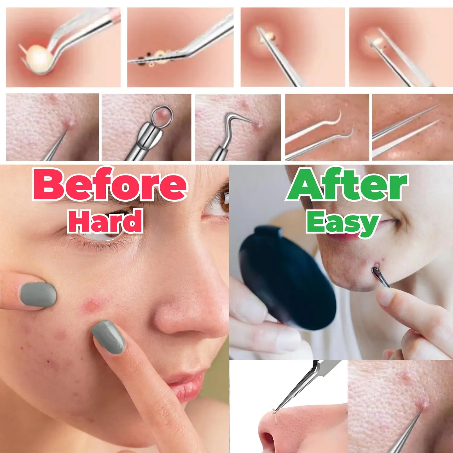 1/8Pcs PcCell 여드름 여드름 제거제 클립 초극세 족집게 검은 점 여드름 추출기 여드름 바늘 페이셜 클리너 스킨