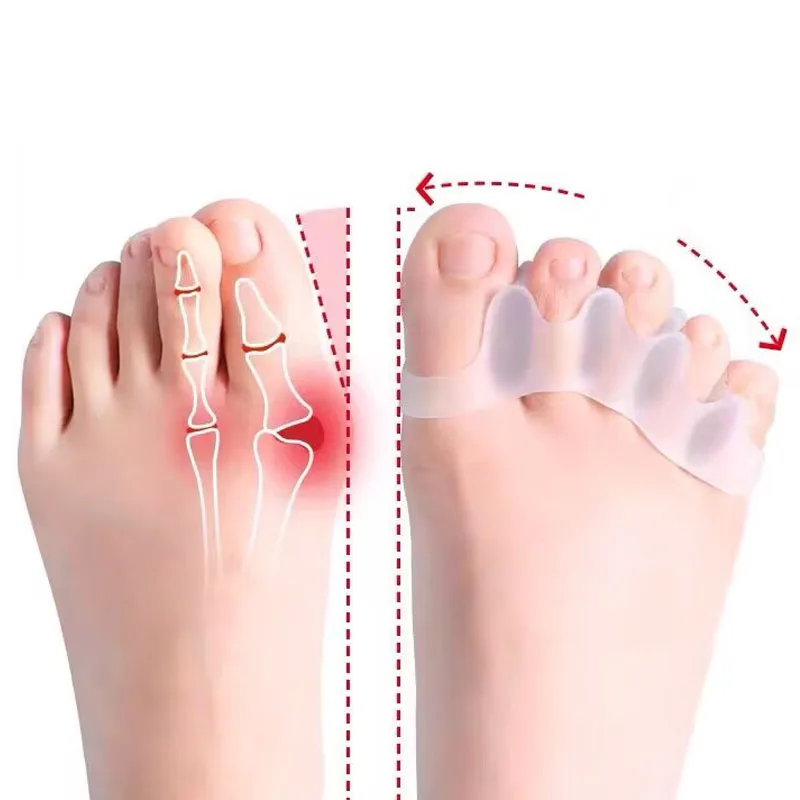 2Pc 실리콘 발가락 분리기 손가락 발 발가락 스프레더 Hallux Valgus Bunion 교정기 발가락 직선 기 교정기 손가락 구분 기호 title=2Pc 실리콘 발가락 분리기 손가락 발 발가락 스프레더 Hallux Valgus Bunion 교정기 발가락 직선 기 교정기 손가락 구분 기호 
